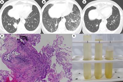 Efficacy of crizotinib retreatment after crizotinib-related interstitial lung disease in a patient with ROS1-rearranged advanced lung adenocarcinoma: A case report and potential crizotinib retreatment strategy
